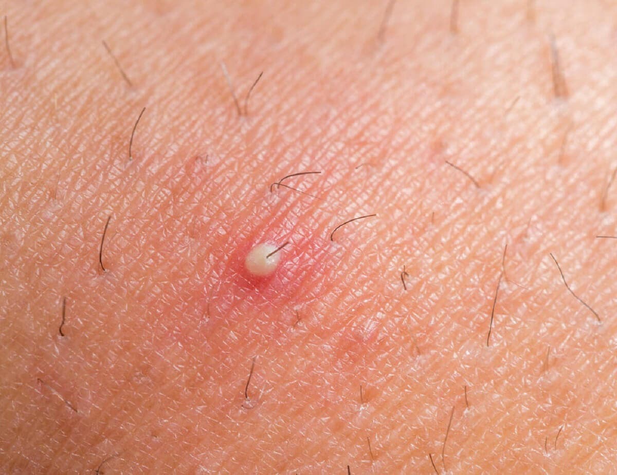 ¿Por qué aparece el dermatofibroma?