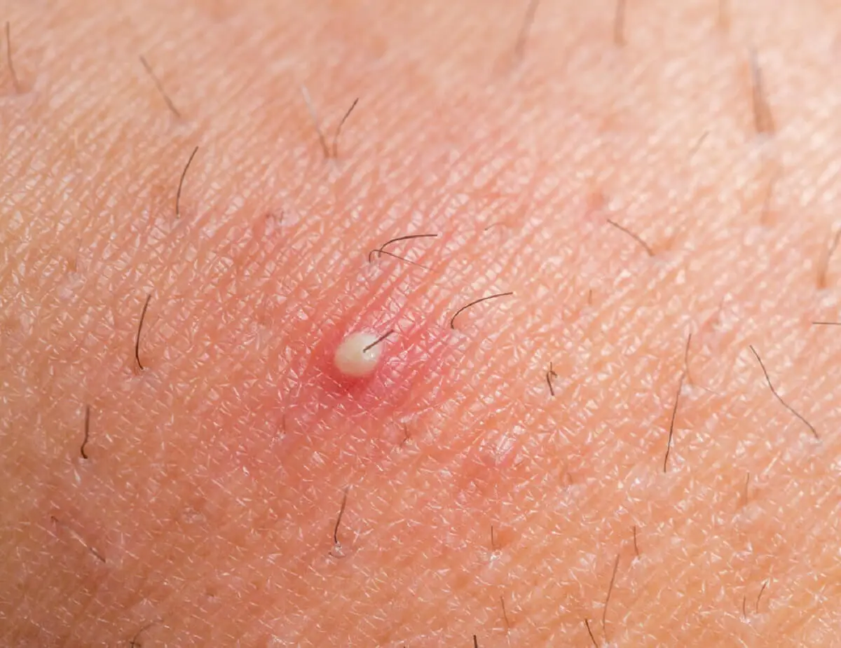 ¿Por qué aparece el dermatofibroma?
