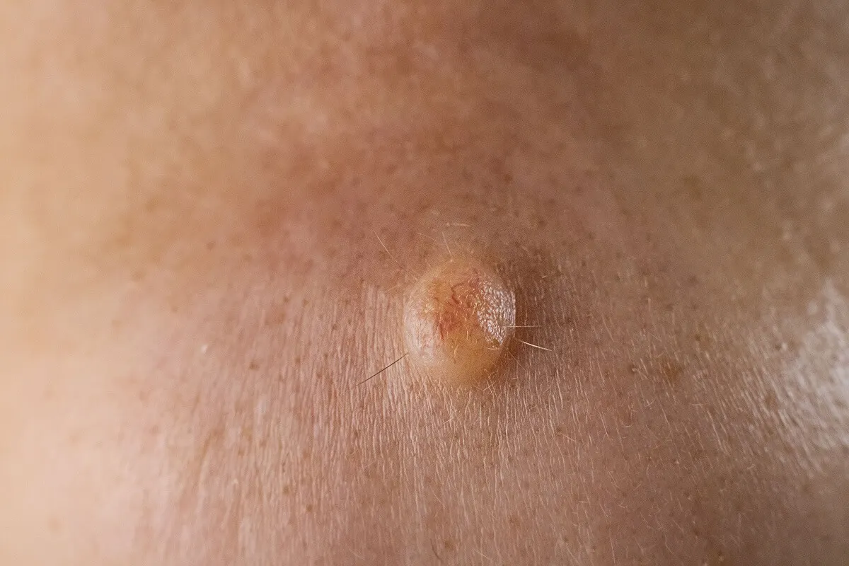 Verrugas por papiloma humano