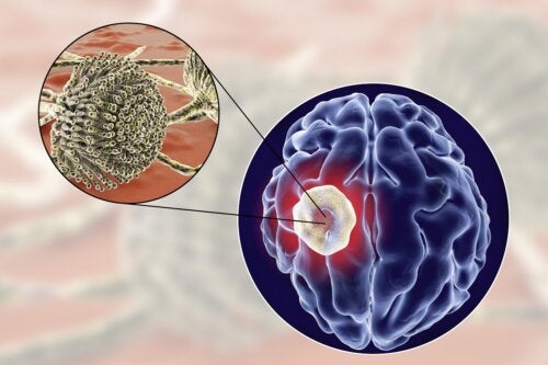 Causas y síntomas del absceso cerebral