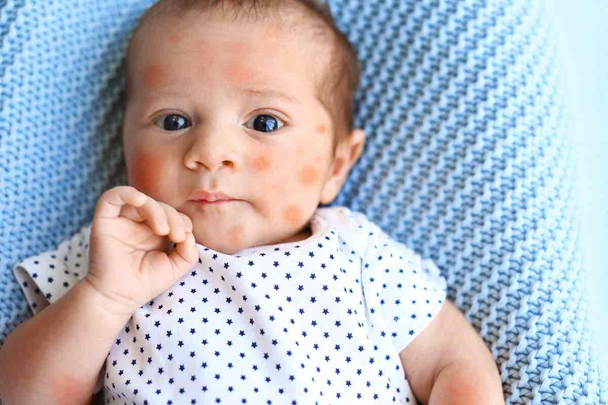 ¿Cuáles son las manchas más comunes en los bebés?