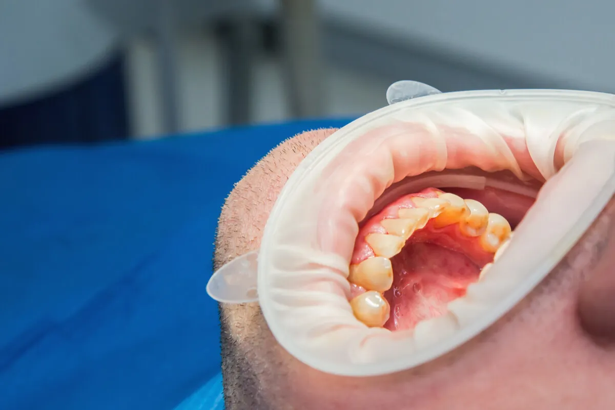 Daños en el esmalte dental.