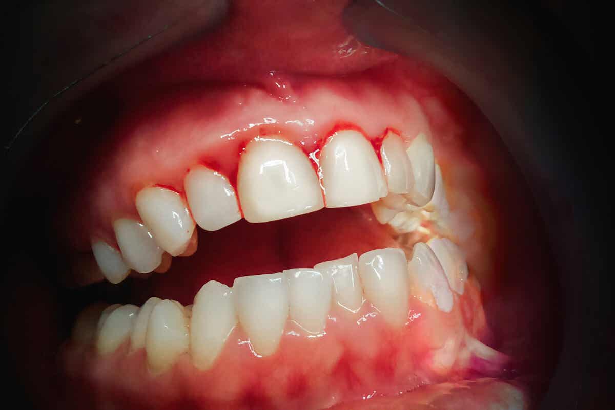 Gingivitis como complicación de los implantes dentales.