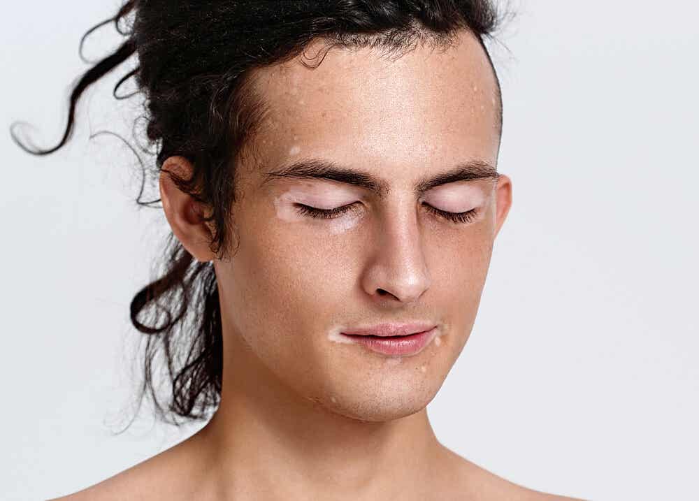 Chico con vitiligo en el rostro