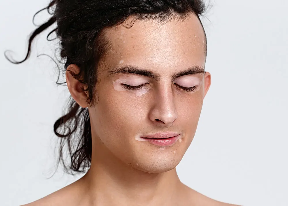 Menino com vitiligo.