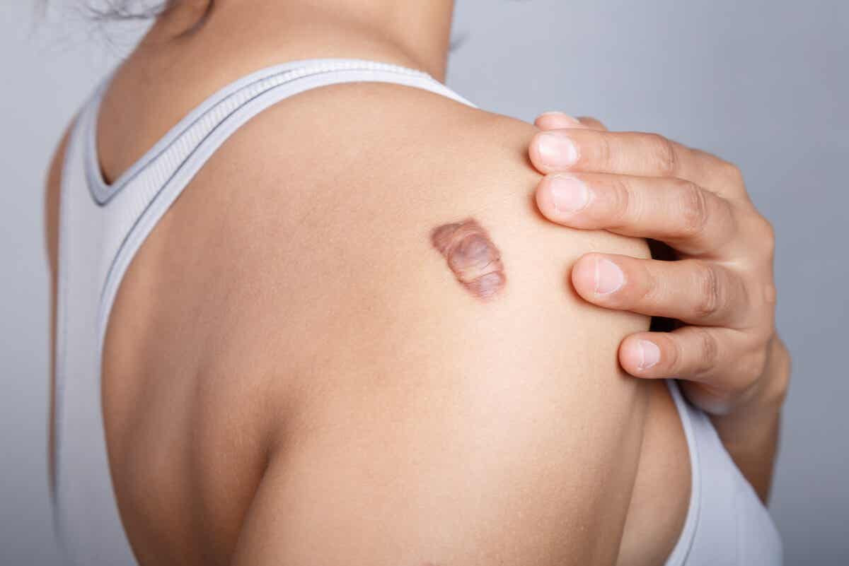 Cicatriz queloide tras quitar un tatuaje con láser.