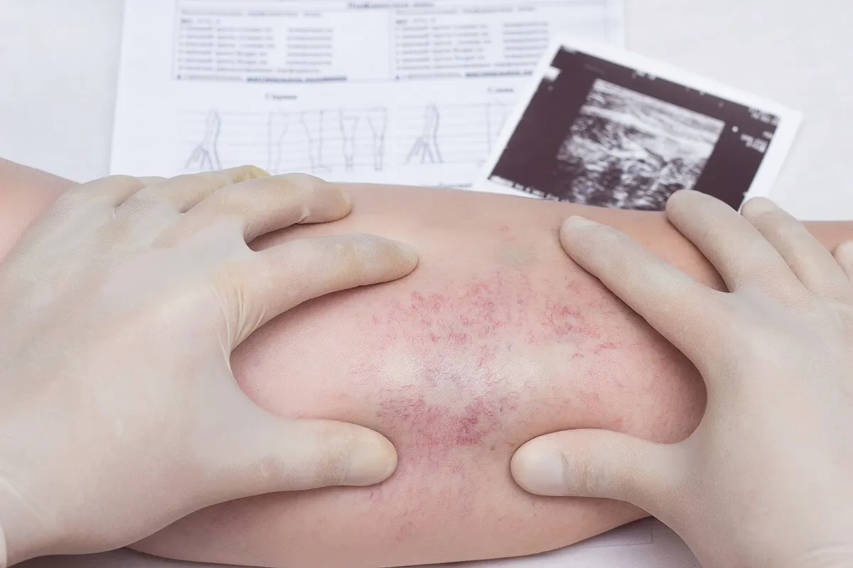 ¿Qué causa la paniculitis?