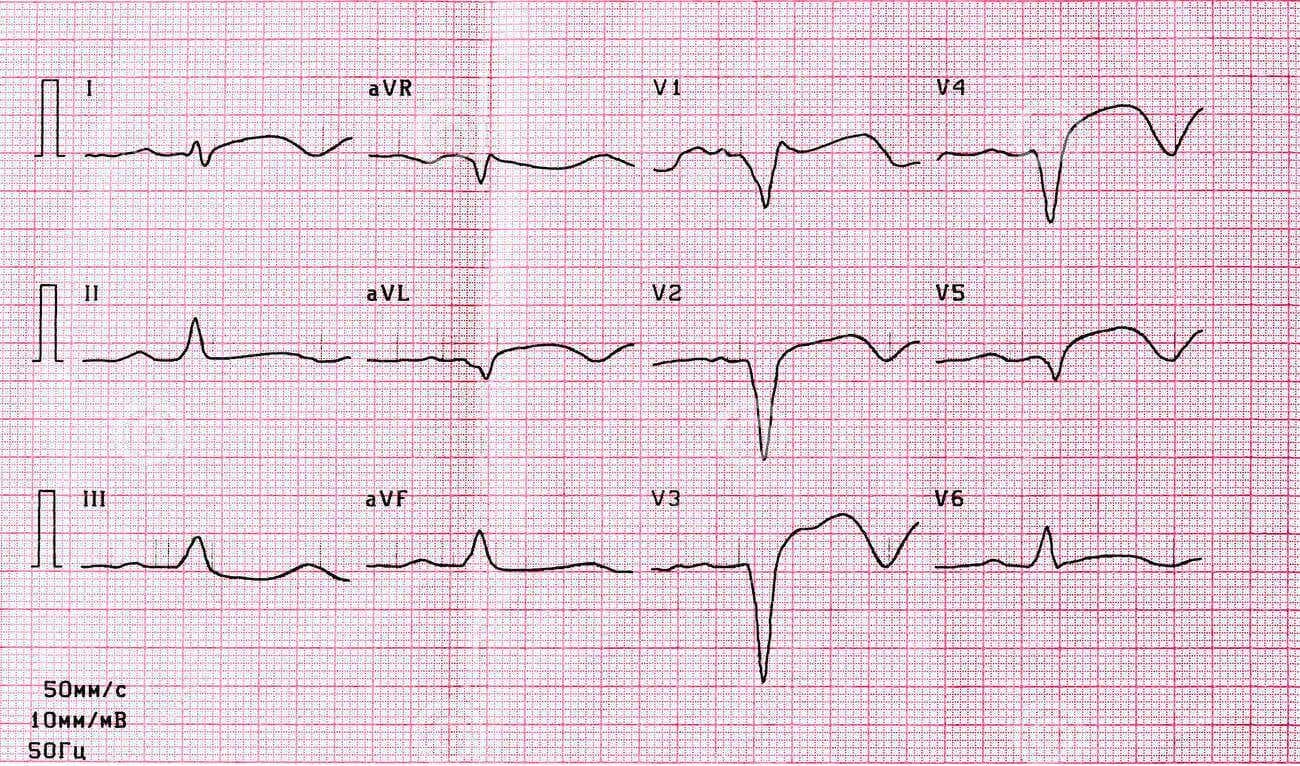 Electrocardiograma con arritmia.