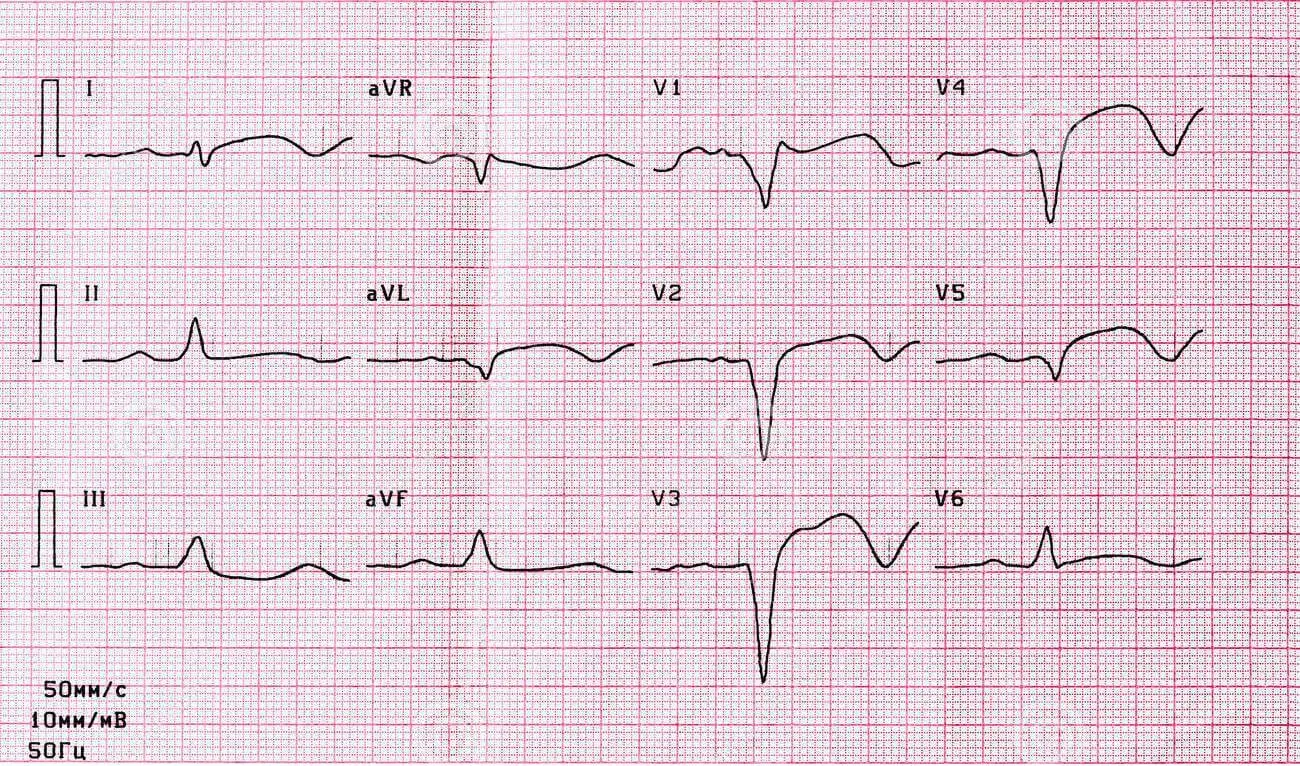 EKG osoby z arytmią