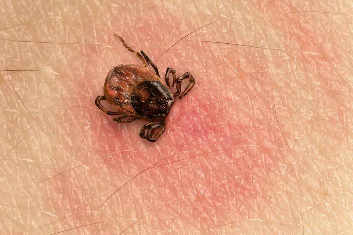 Rocky Mountain spotted fever from a tick