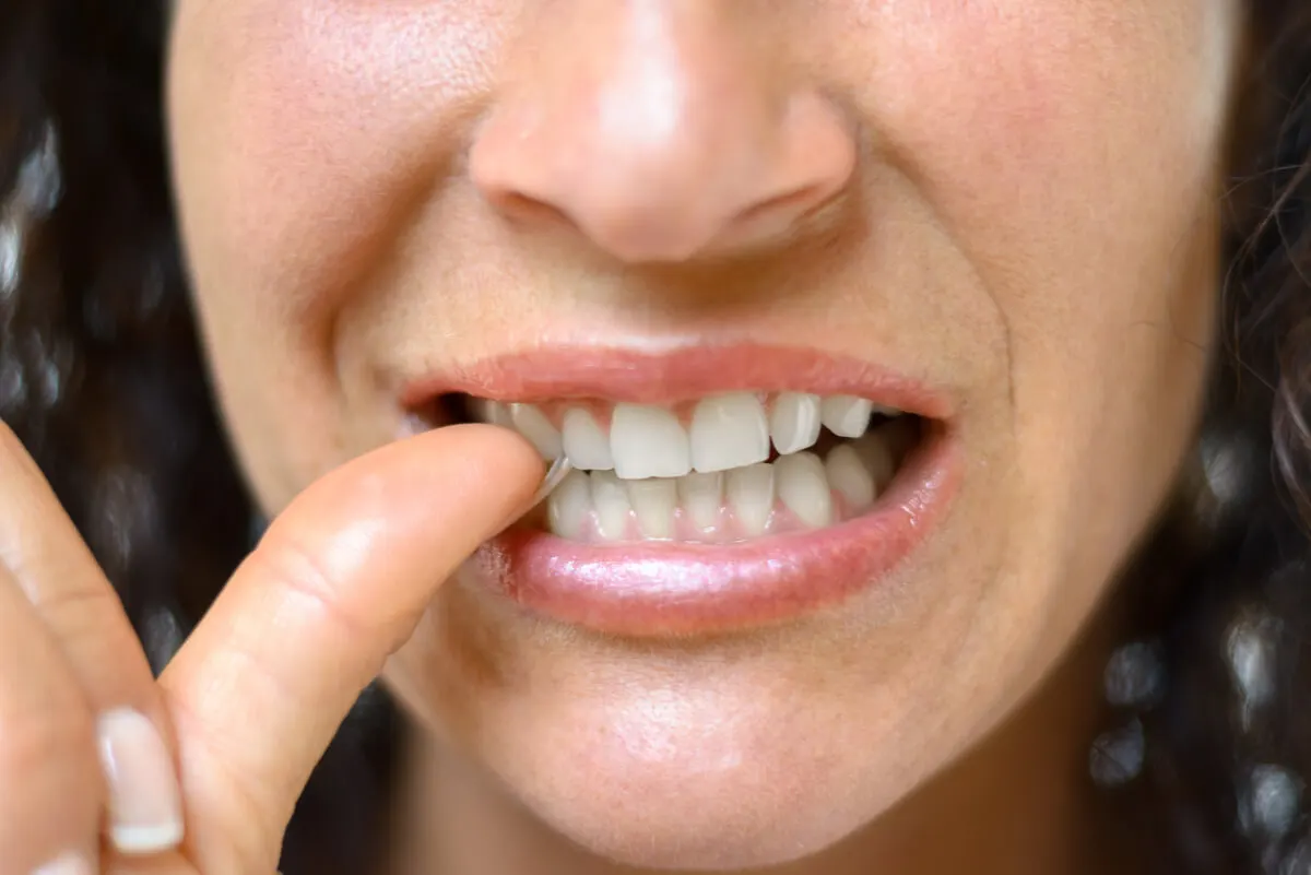 Morderse las uñas causa fisura dental.