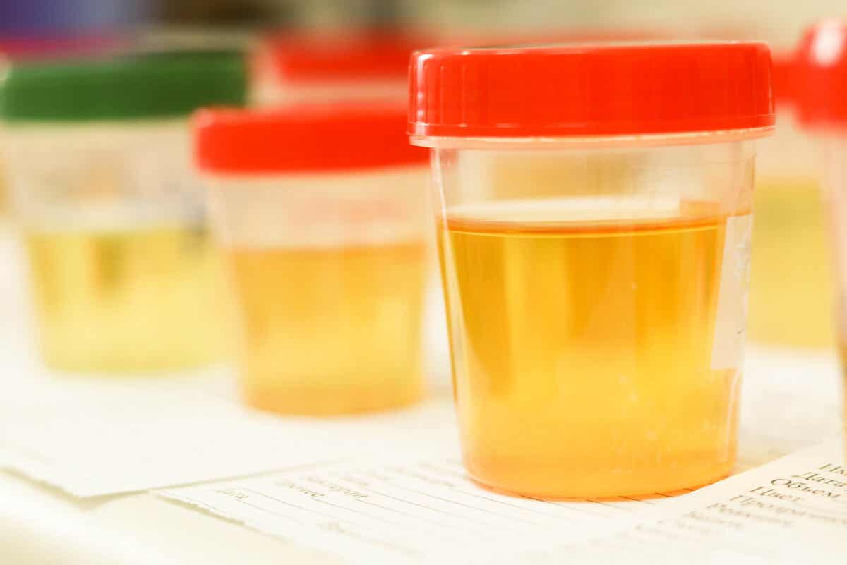 Veränderte Urinfarbe - orangefarbener Urin