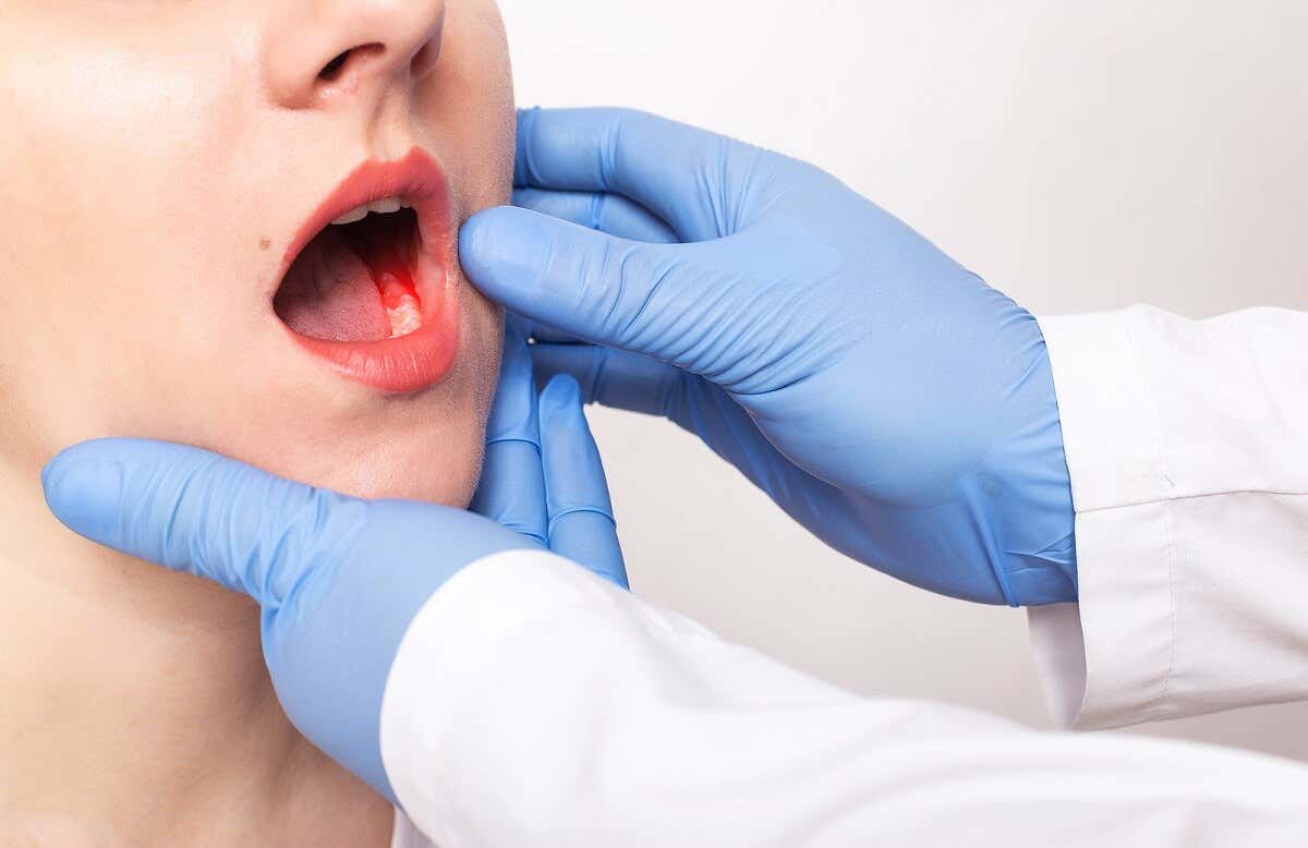 Qu'est-ce que la parodontite ?