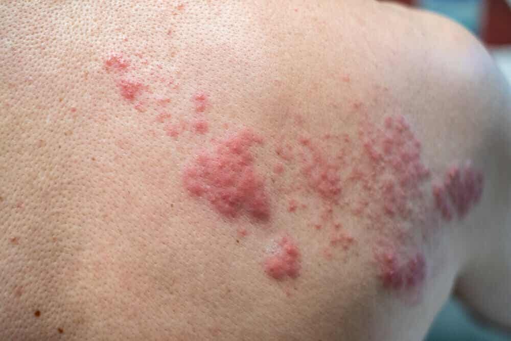 Herpes en la piel como causa de la enfermedad de Behcet.