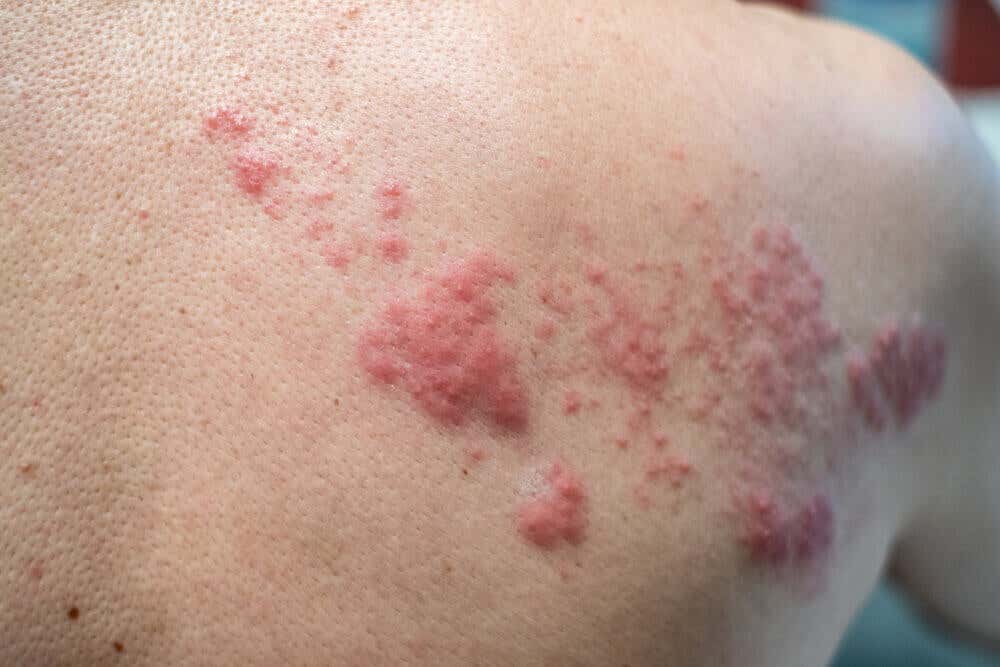 Herpes en la piel como causa de la enfermedad de Behcet.
