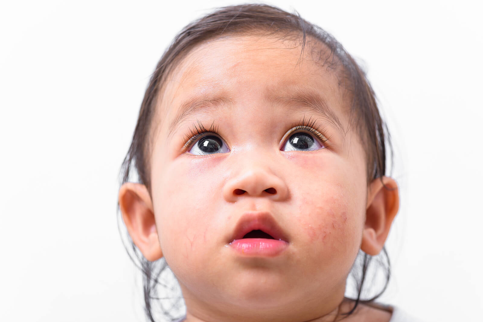 La pitiriasis alba es común en niños.