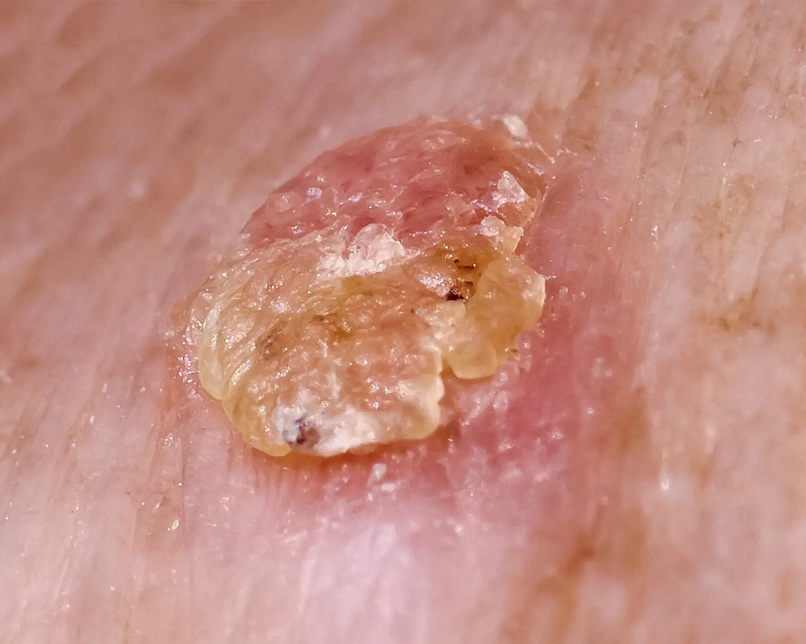 Queratosis solar de cerca