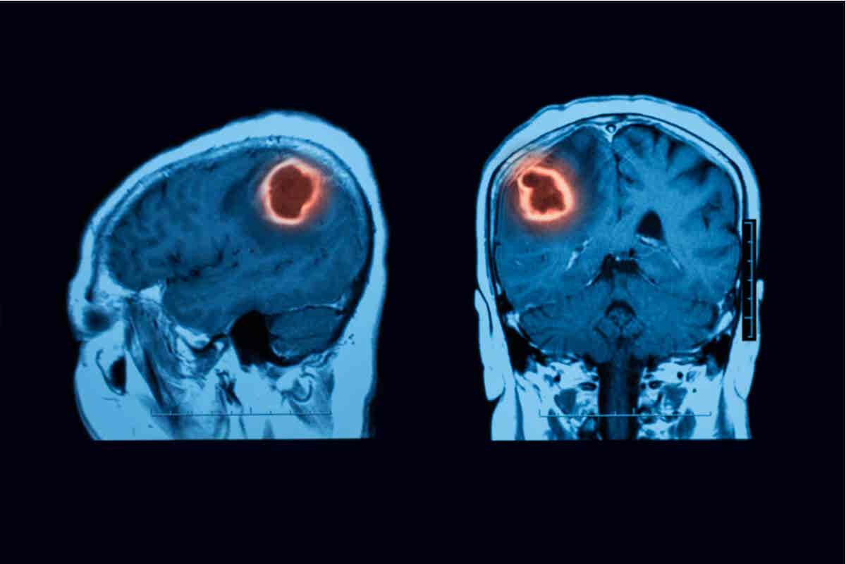 RMN de cerebro con hematoma subdural.
