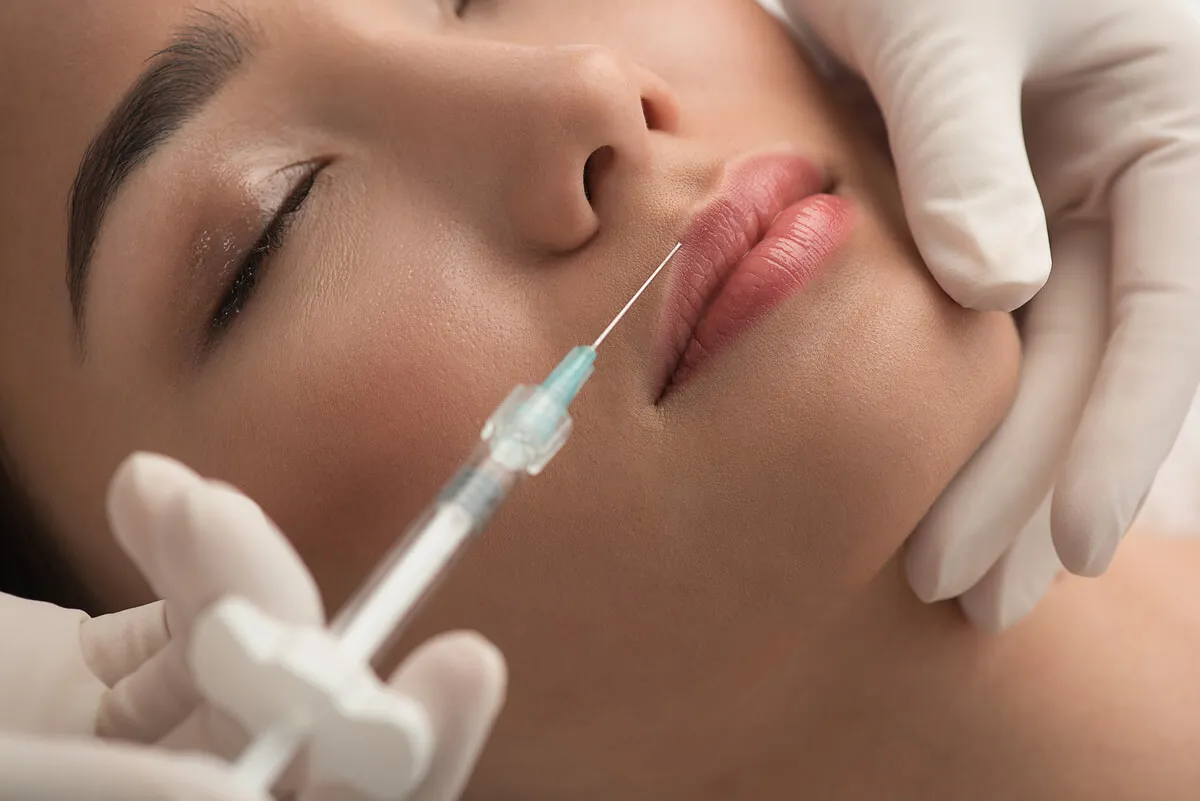 Rhinomodellierung - Hyaluronsäureinjektion in die Lippen