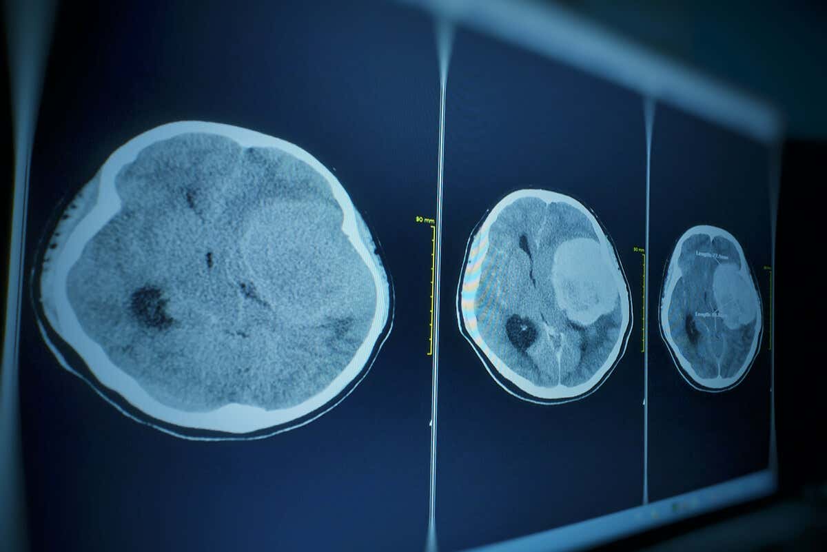 Tomografía de cerebro por meningioma