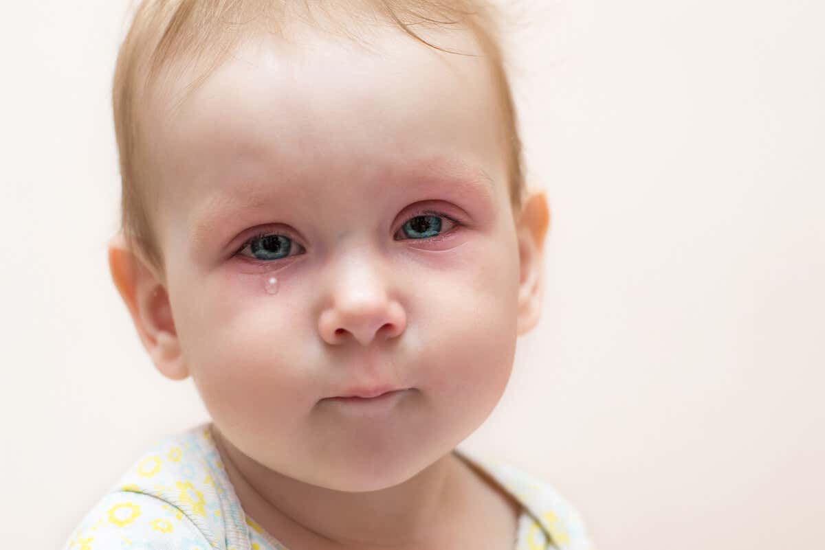 Conjuntivitis en niño con conducto lagrimal obstruido.