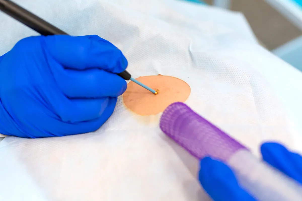 Biopsia de piel para diagnóstico de mastocitosis.