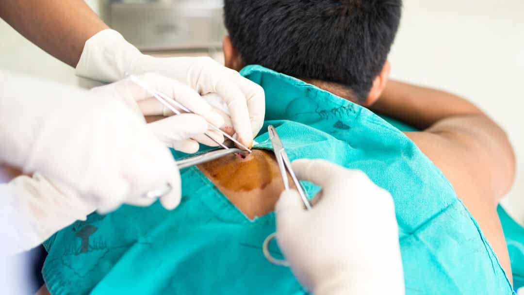 ¿Qué es la biopsia de piel? Mejor con Salud Tratamientos médicos ¿Qué es la biopsia de piel? Mejor con Salud Tratamientos médicos