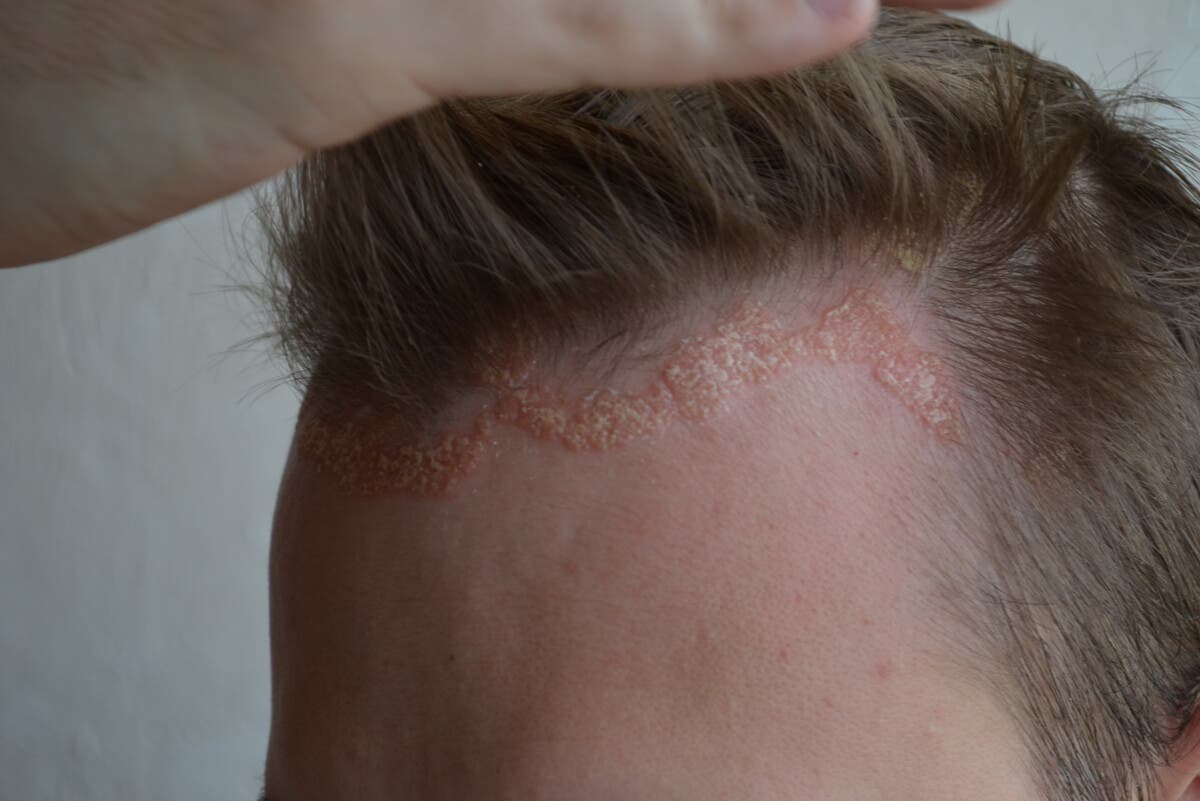 Psoriasis en cuero cabelludo.
