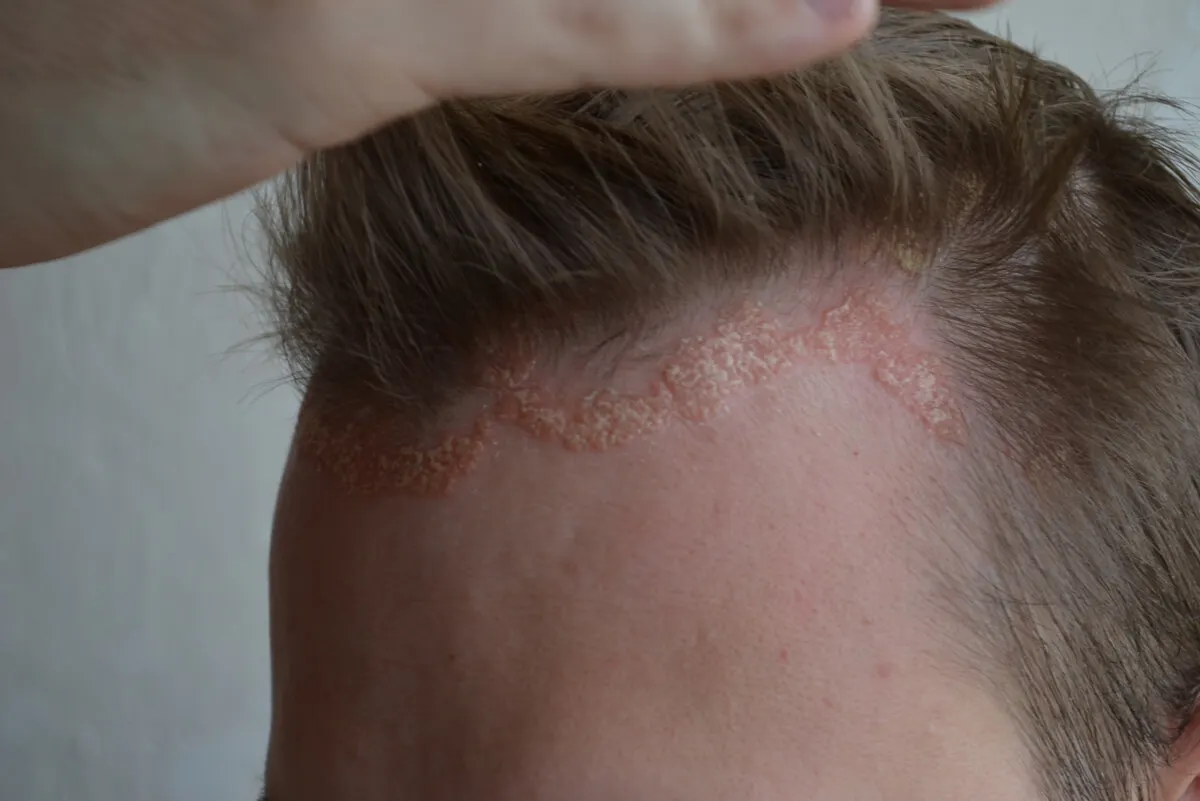 Psoriasis en cuero cabelludo.