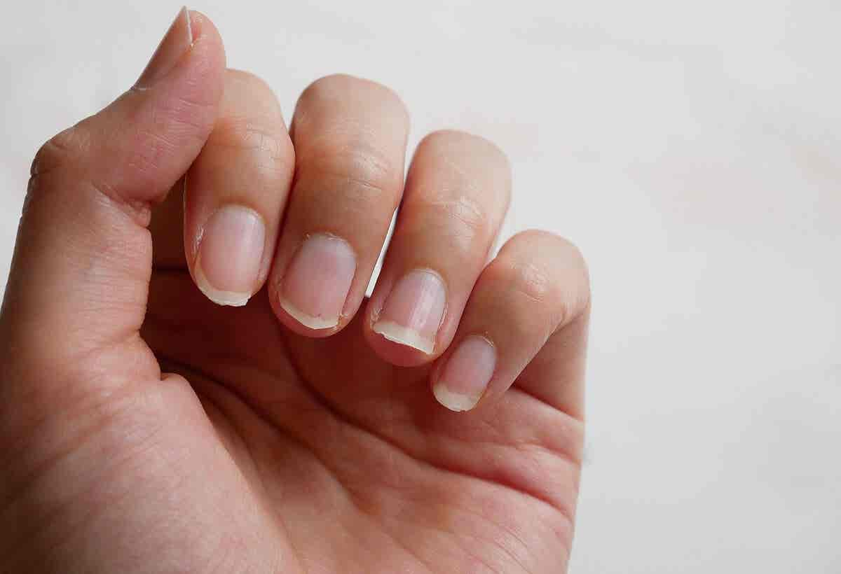 Onychorrhexis - Hand mit abgebrochenen Nägeln