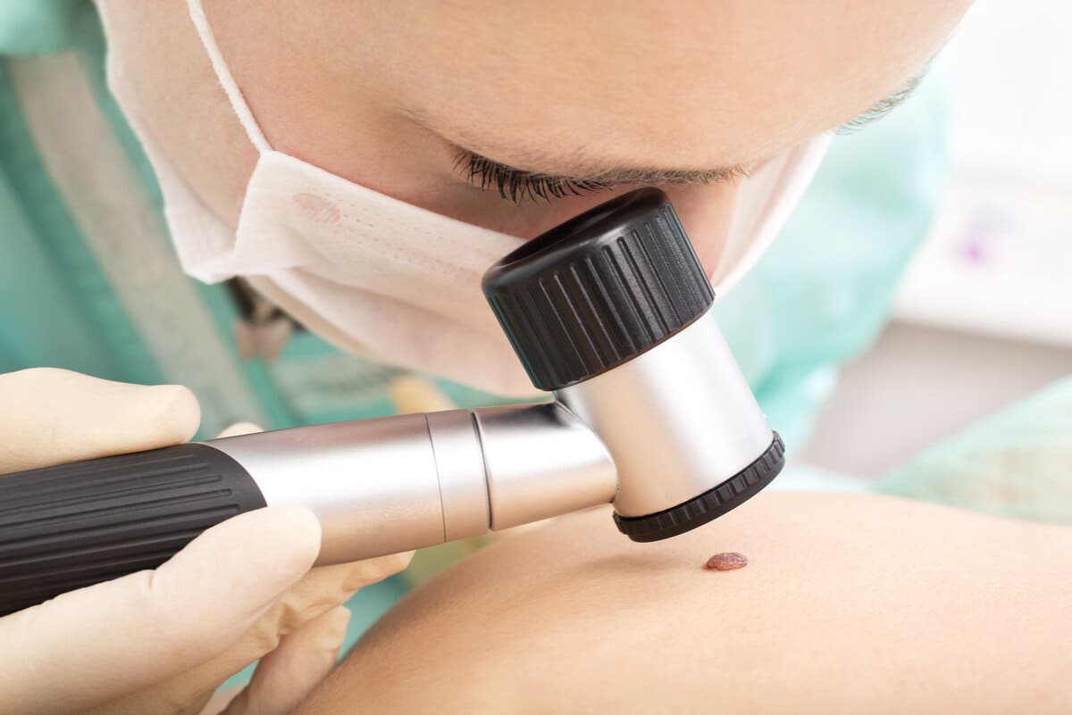 Revisación de cáncer de piel.