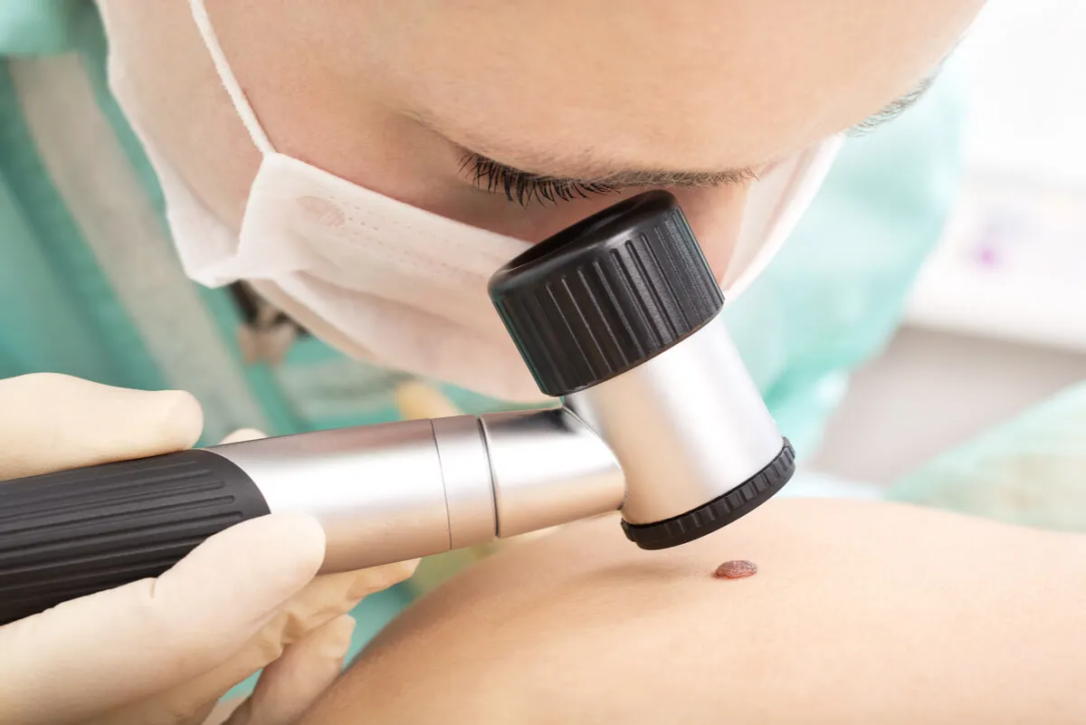 Revisación de cáncer de piel.