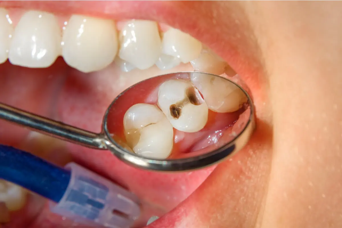 Caries en paciente fumador.