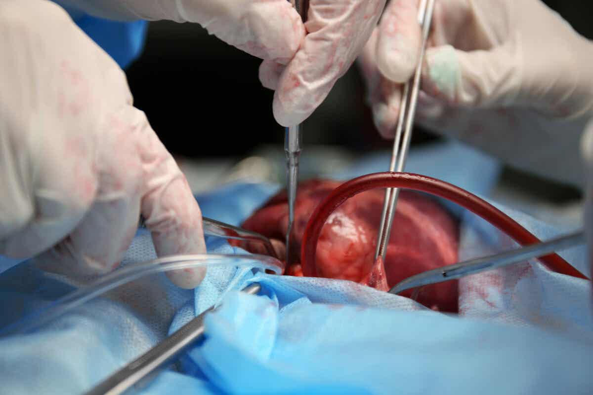 Cirugía del corazón con uso de anticoagulantes.
