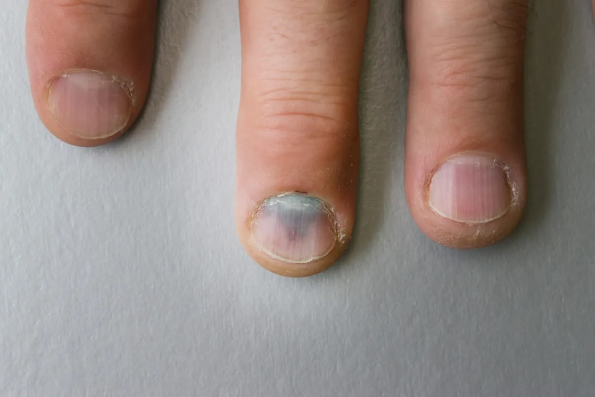 Hematoma de la uña.