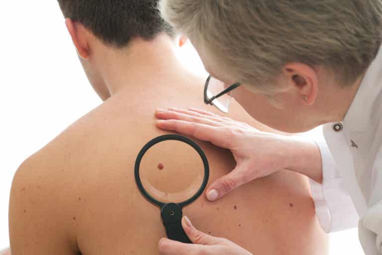 Tratamiento del cáncer de piel (melanoma)