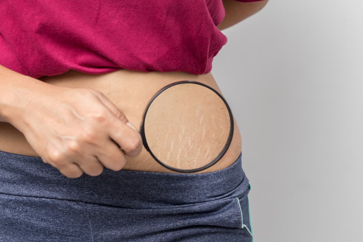 Estrías en el abdomen con celulitis.