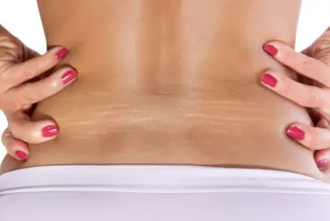 ¿Qué tipos de estrías hay?