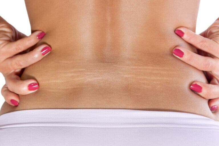 Dile adiós a las estrías con estos remedios naturales
