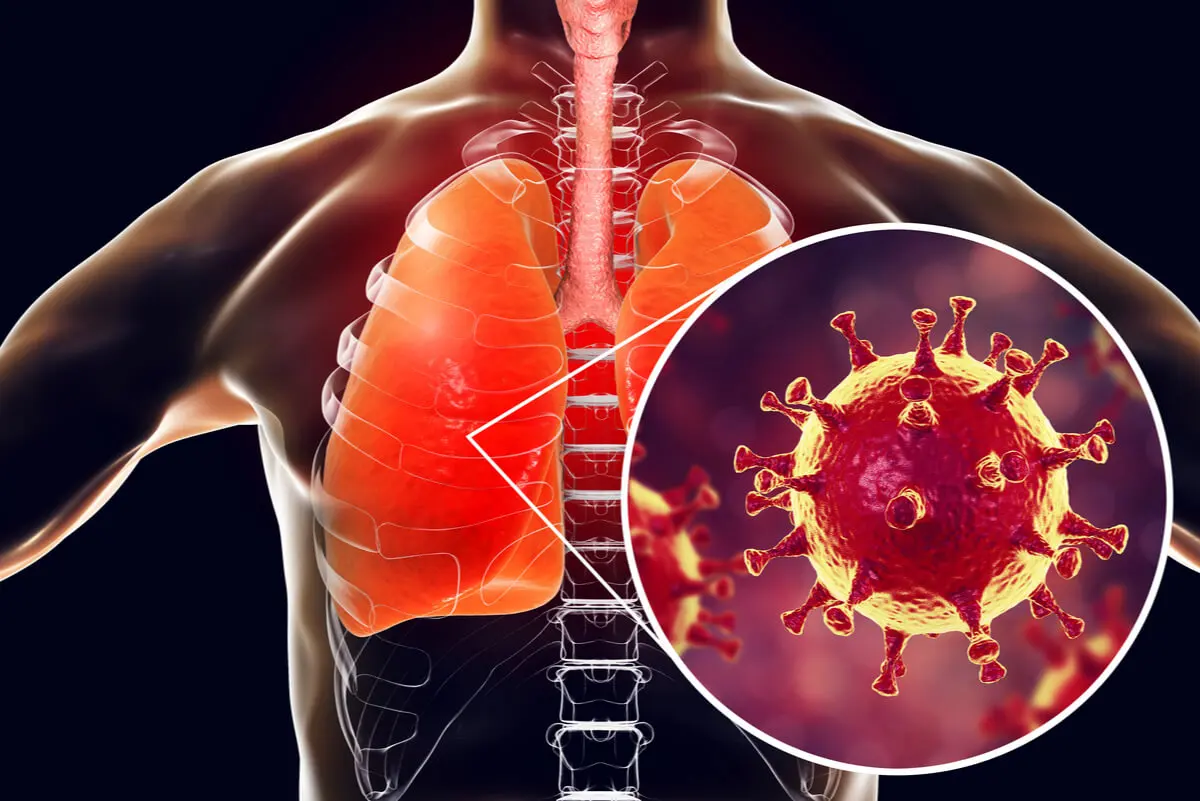 Infección en los pulmones.