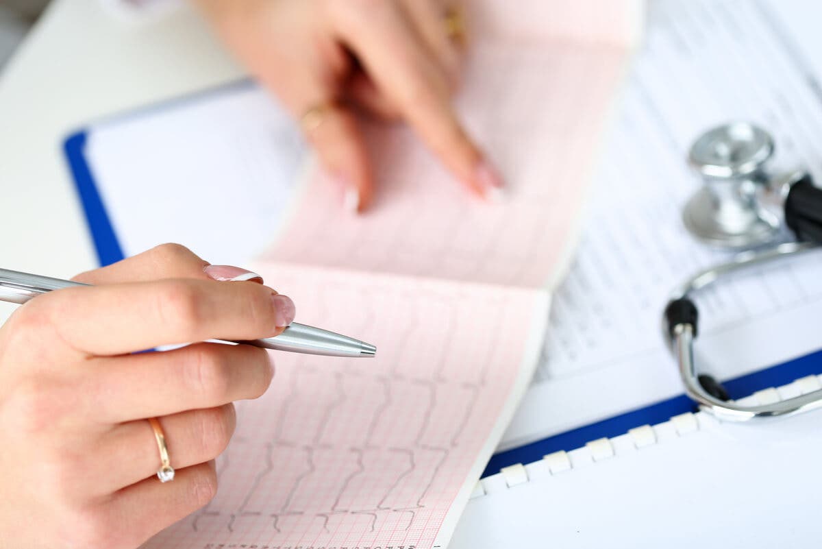 Électrocardiogramme qui diagnostique l'arythmie.