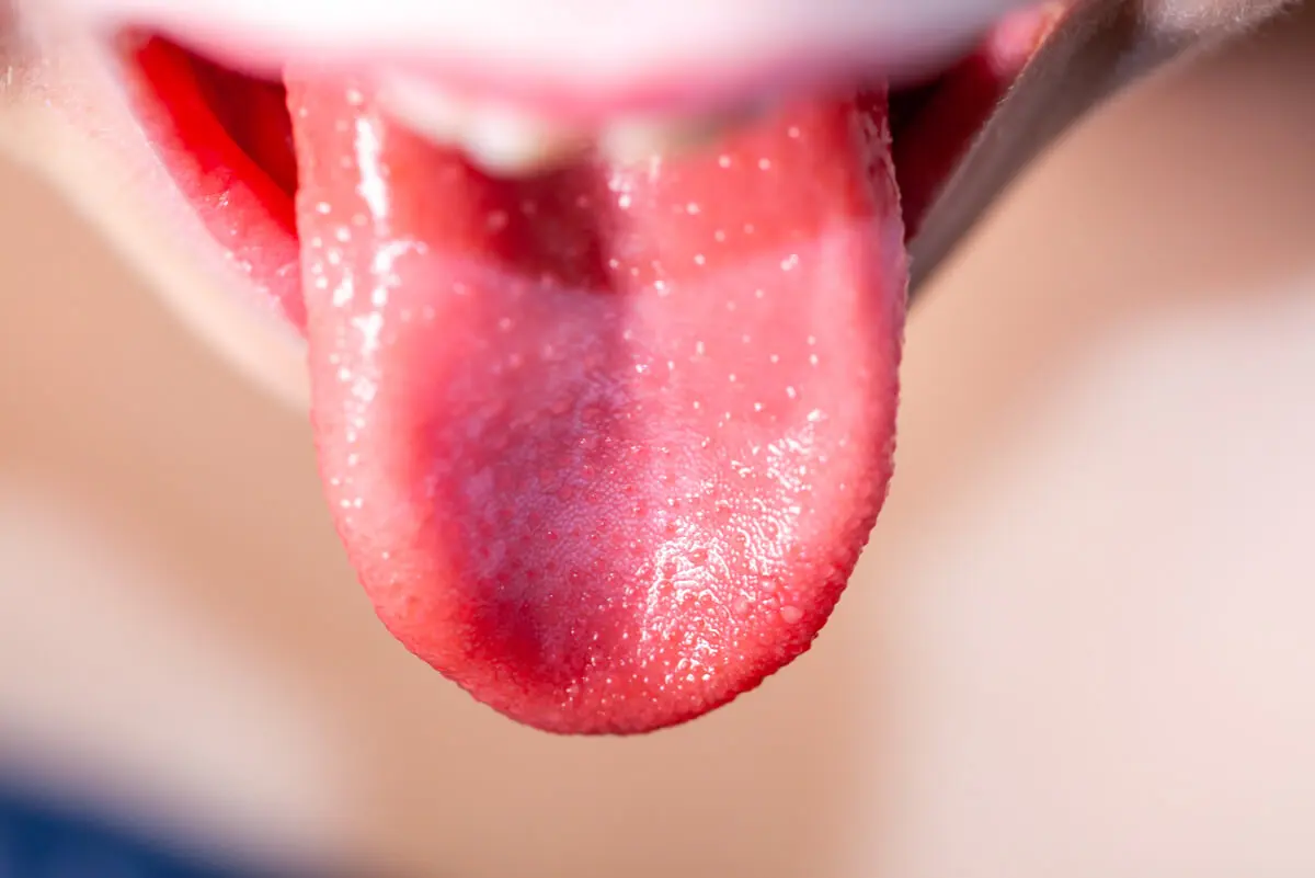 Lengua con escarlatina.