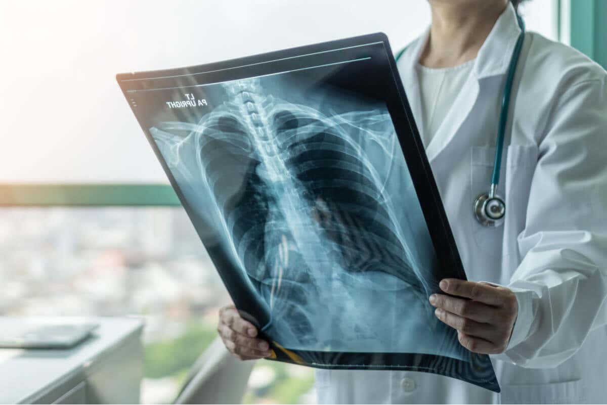 Detección de tuberculosis pulmonar con radiografía.