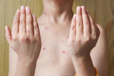 Herpes zoster en niños: causas, síntomas y tratamientos
