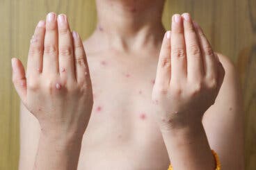 Herpes zoster en niños: causas, síntomas y tratamientos