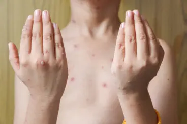 Herpes zoster en niños: causas, síntomas y tratamientos