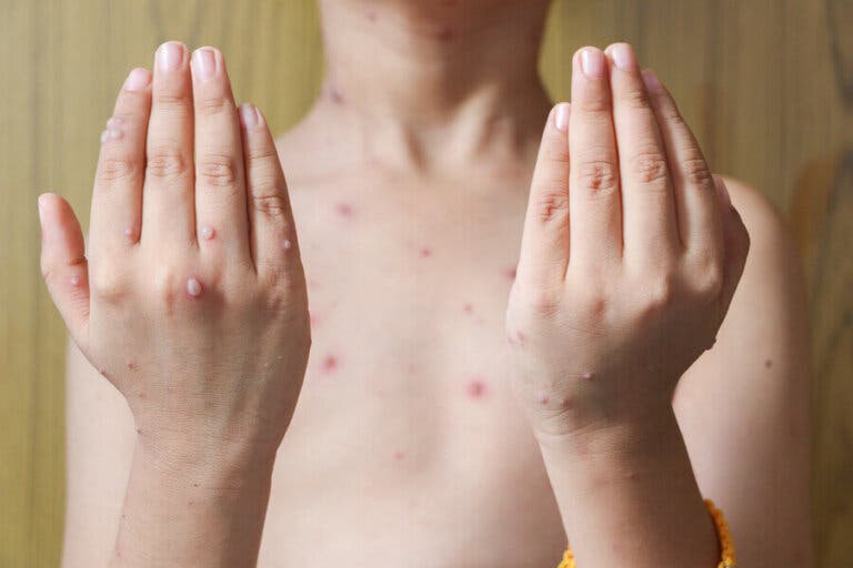 Herpes zoster en niños: causas, síntomas y tratamientos