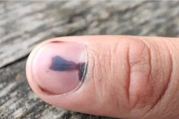 ¿Qué es y cómo tratar un hematoma subungueal?