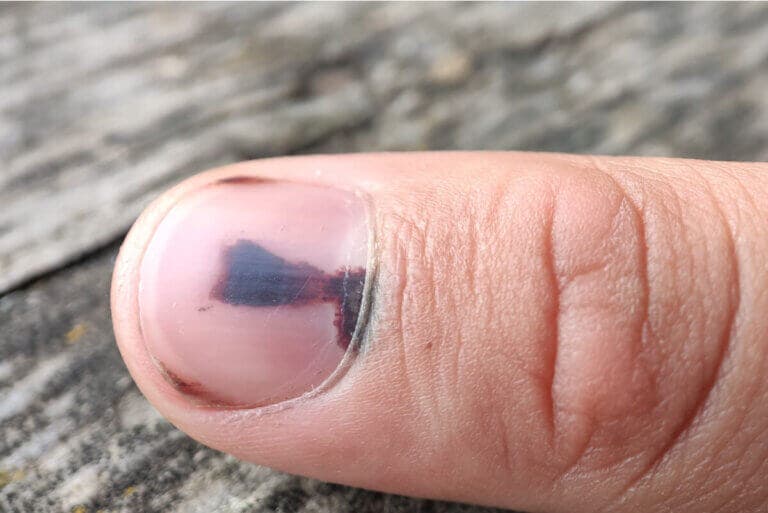 ¿Qué es y cómo tratar un hematoma subungueal?