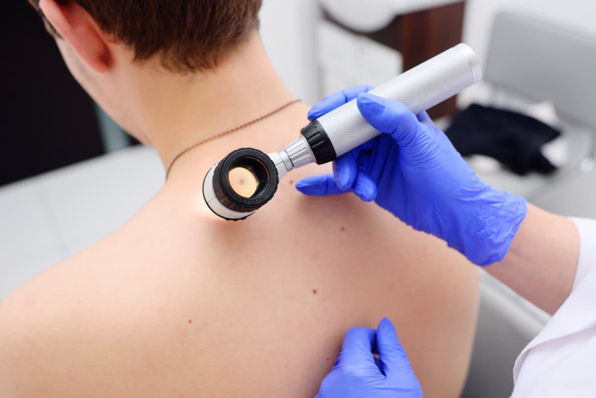 Dermatólogo observa lesión de piel.